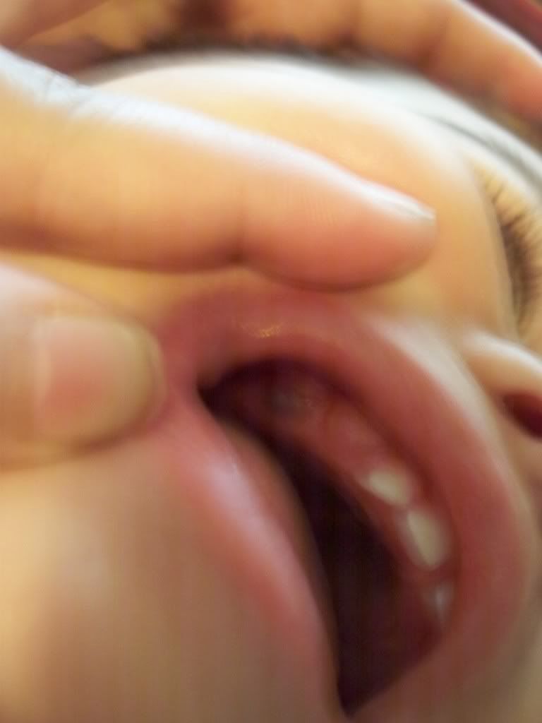 swollen baby gums
